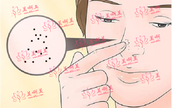 黑头太影响个人形象了，去黑头方法一览！快来试试有用吗？