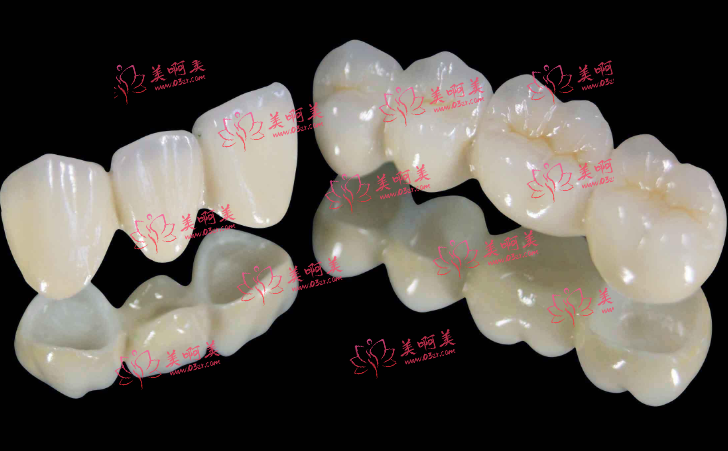 烤瓷牙和全瓷牙哪个好?来看看优缺点对比吧！还有使用时间分享