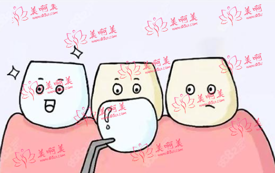 牙齿贴面修复选树脂贴面还是瓷贴面？除贴面外，还有哪些修复方式？