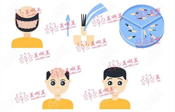 佛山广大医疗美容在哪？植发项目种类展示！网友评价正规疗效好！