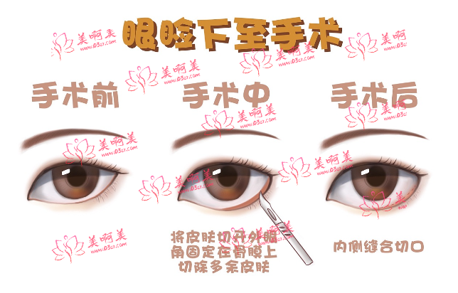 北京眼睑下至手术好的医院推荐:华韩、美莱、克莱美舍、美媛荟都是靠谱的选择! 北京眼睑下至手术好的医院推荐:华韩、美莱、克莱美舍、美媛荟都是靠谱的选择!