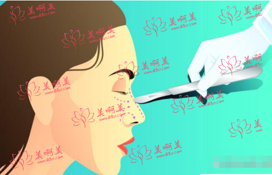 北京膨体隆鼻医生排行榜更新！李劲良/刘彦军/牛永敢等技术都不错
