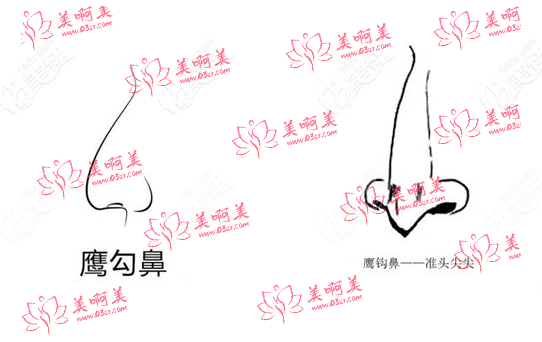 北京鹰钩鼻矫正医院排行榜曝光！top10全是资质、实力、口碑都在线的医院！