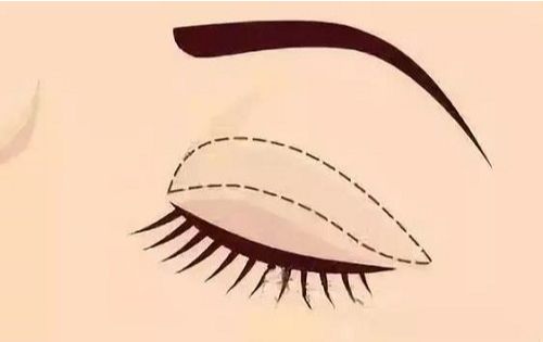 重庆双眼皮价格公布！另有重庆做双眼皮自然的医院推荐！