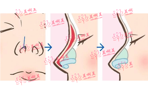 北京自体脂肪隆鼻医生排名出炉！看看医生实力，坐诊医院一览！