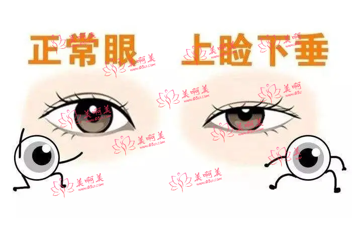 上海九院究竟好在哪里？揭秘王琛医生的上睑下垂技术！