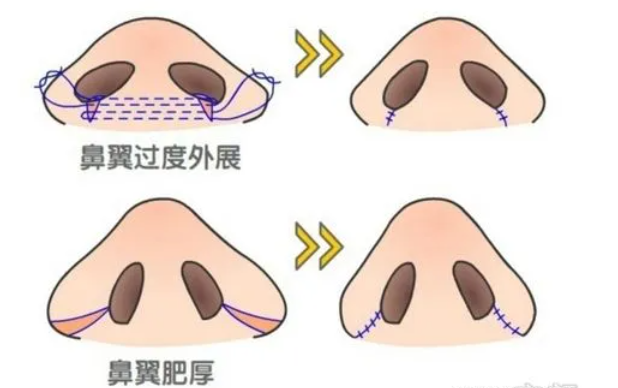上海地区缩小鼻翼鼻头手术价格参照！当地热门医院收费情况对比！