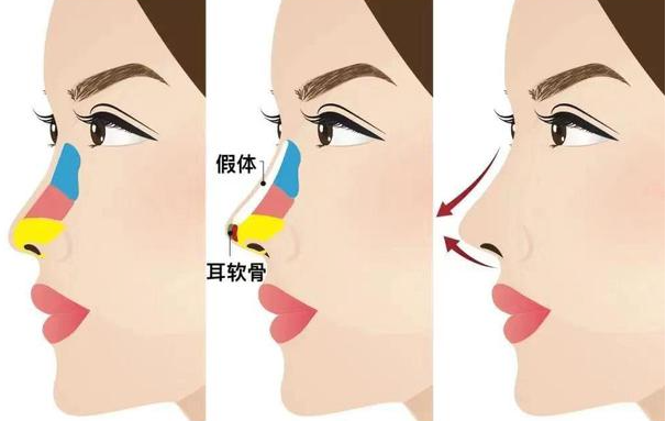 长沙雅美整形热门项目怎么收费的？隆胸、隆鼻、吸脂等性价比超高的！