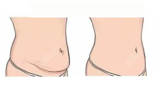 腹部拉皮手术项目科普：价格、流程、优劣势、注意事项等全面解析！