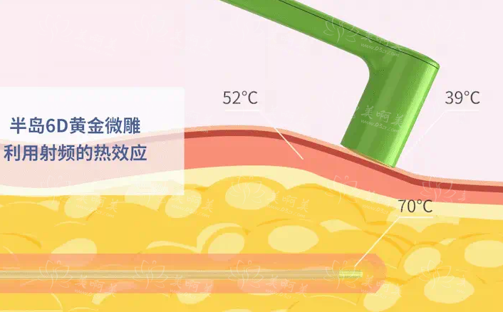 黄金微雕吸脂和普通吸脂区别对比:原理、优势、效果等多方面比较! 黄金微雕吸脂和普通吸脂区别对比:原理、优势、效果等多方面比较!