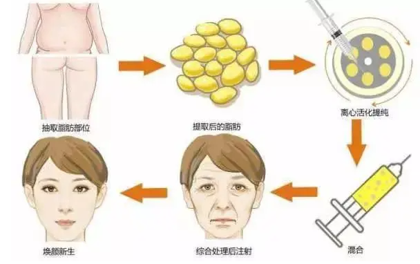 南京华韩奇致做脂肪填充实力如何？技术在线，收费合理！更有案例分享~
