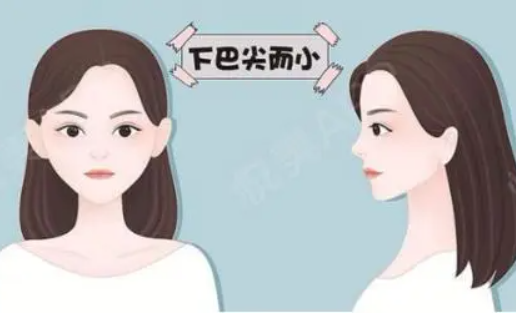 丰下巴的手术方式有哪些？适合人群、术前准备全面解析！