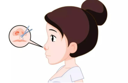 北京嘉禾妇儿医院隆鼻手术多少钱？技术优势、真实案例分享！