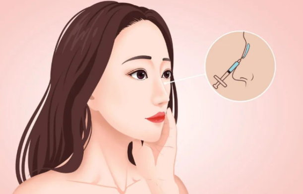 河南芳艺疗美容医院玻尿酸注射隆鼻原理解析,技术优势、术后注意事项分享 河南芳艺疗美容医院玻尿酸注射隆鼻原理解析,技术优势、术后注意事项分享