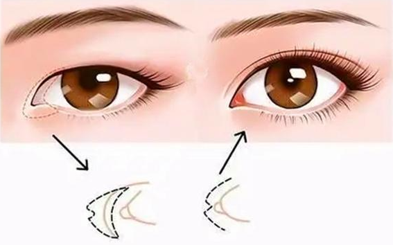 开眼角手术后会出现增生吗？下面来给大家做出解答！