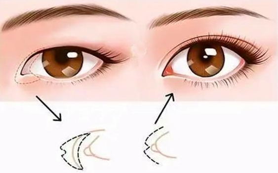 如何缩短开眼角手术的恢复时间
