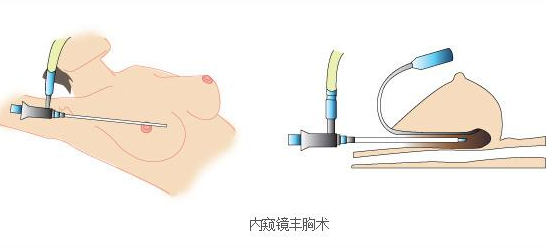 北京嘉禾董岩岩做内窥镜隆胸人气超高？还有内窥镜隆胸与妈生胸区别解析
