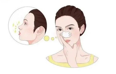 鼻子注射玻尿酸多少钱 ？大概的价格区间是什么？