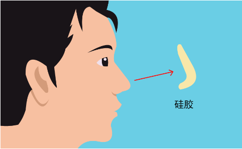 朝天鼻整容效果可以一直保持吗？假体可以一直不取出来吗？