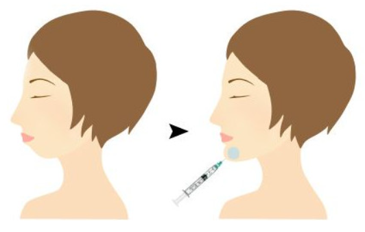 下巴打玻尿酸大概需要多少量？