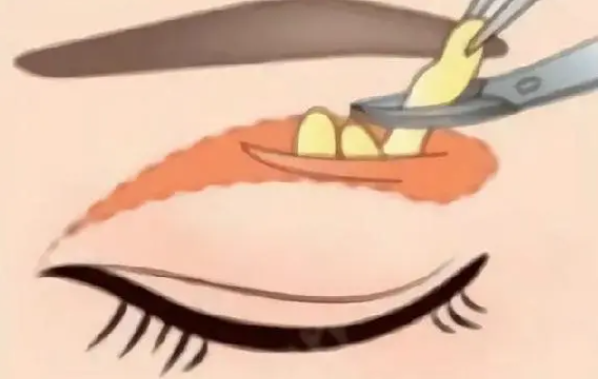 什么是肿泡眼抽脂，有什么好处