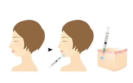 下巴注射玻尿酸很硬的原因是什么?