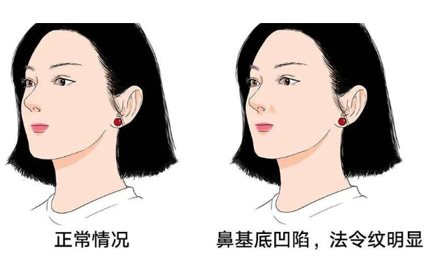 垫鼻基底会不会不自然，会影响面部表情吗