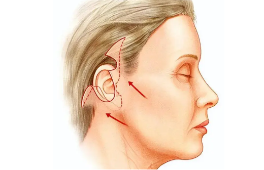 筋膜悬吊提升术：了解潜在副作用的重要性