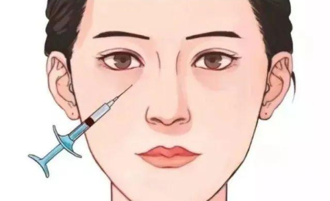 胶原蛋白填充泪沟恢复期需要多久?