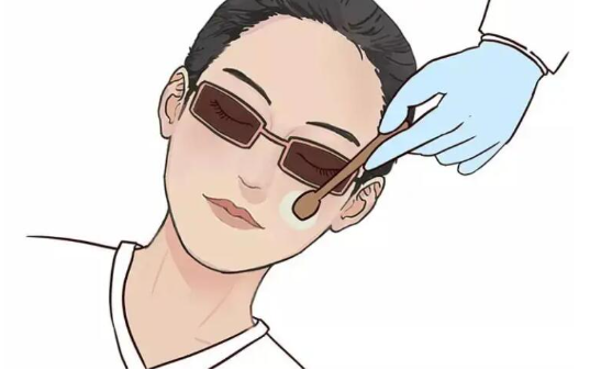 光子嫩肤：功效与副作用在线解答
