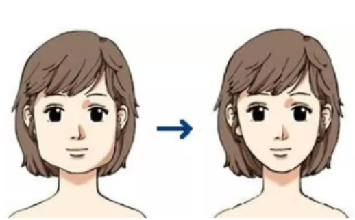 吸脂瘦脸:方法、效果与注意事项全解析 吸脂瘦脸:方法、效果与注意事项全解析