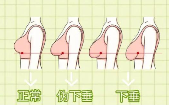 胸部下垂提升方法：乳房悬吊提升手术全解析