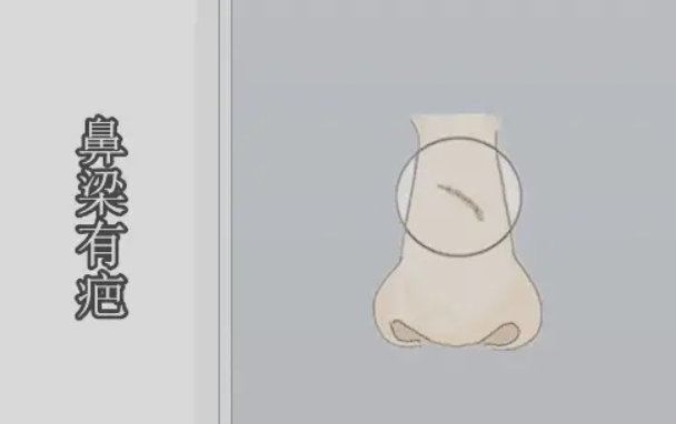 鼻梁上的疤痕如何进行有效修复