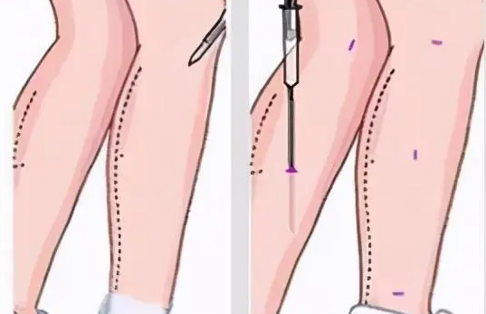 大腿抽脂手术会不会出现后遗症？
