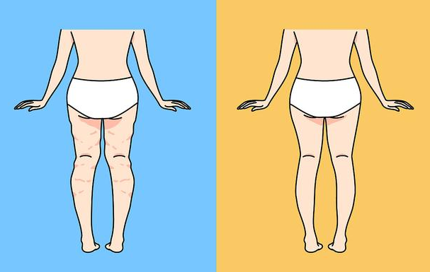 吸脂瘦大腿：效果与适用人群分析