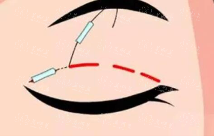 双眼皮手术后出现肉条眼该如何处理？
