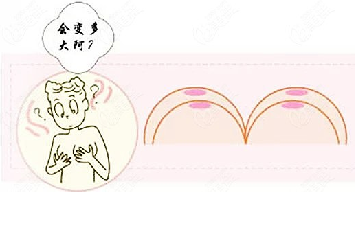 假体隆胸术后复查时间解析