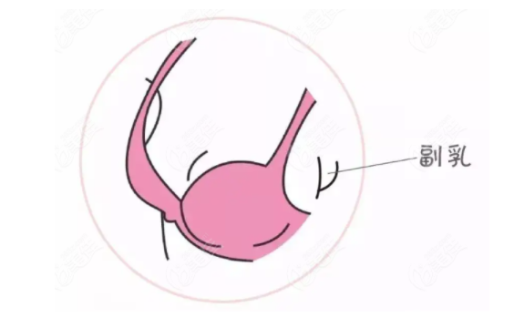 副乳吸脂：塑造自信美丽的身姿