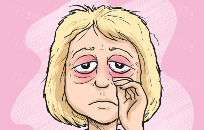 了解眼袋去除手术风险与效果分析 了解眼袋去除手术风险与效果分析