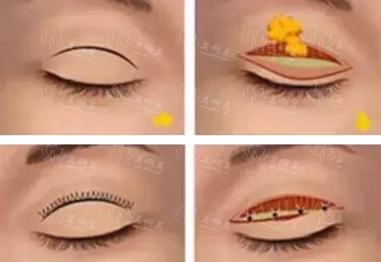 眼皮抽脂是否存在风险？