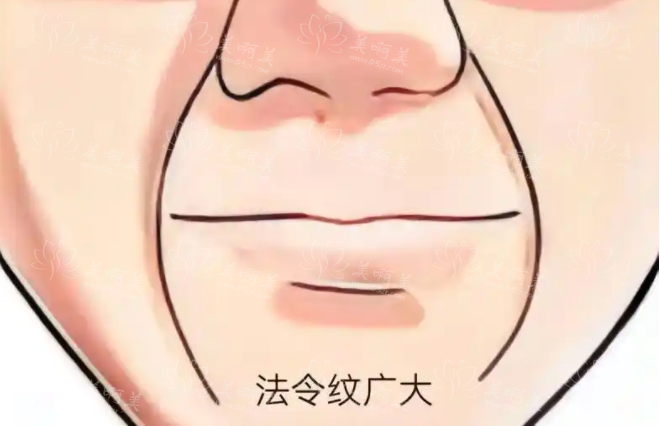 面部脂肪填充法令纹:重塑青春轮廓的奇妙之旅 面部脂肪填充法令纹:重塑青春轮廓的奇妙之旅