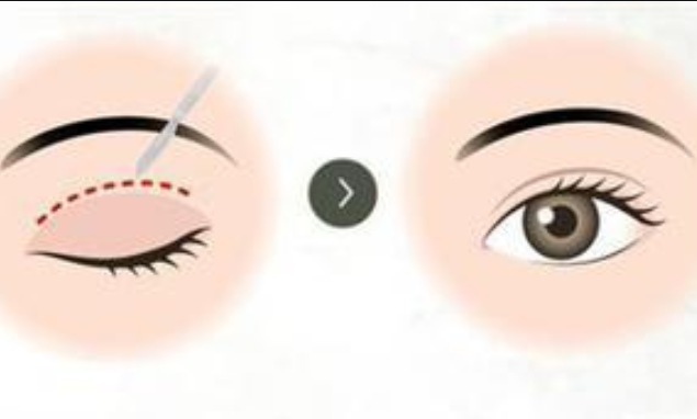 双眼皮手术是否可以在全麻状态下进行？