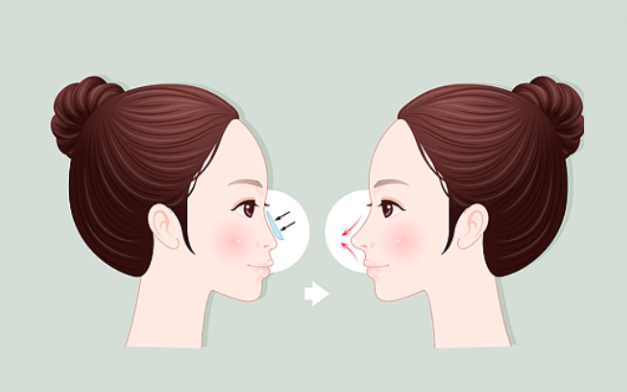 上海华美整形擅长做鼻综合吗？医生实力、项目科普等曝光！