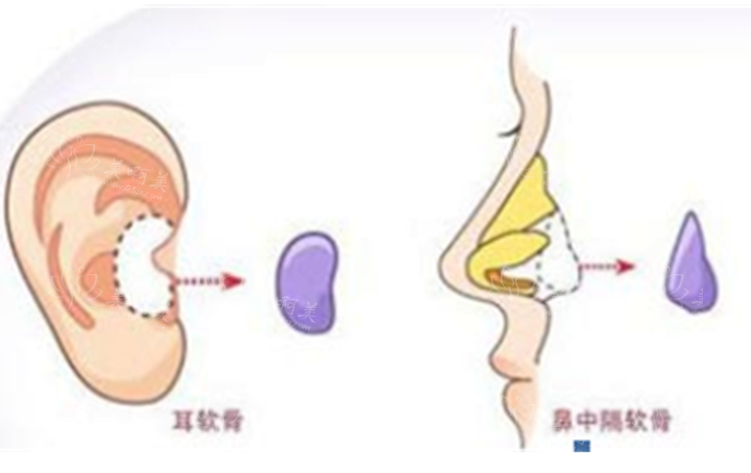 耳软骨隆鼻后鼻尖发白是否严重？