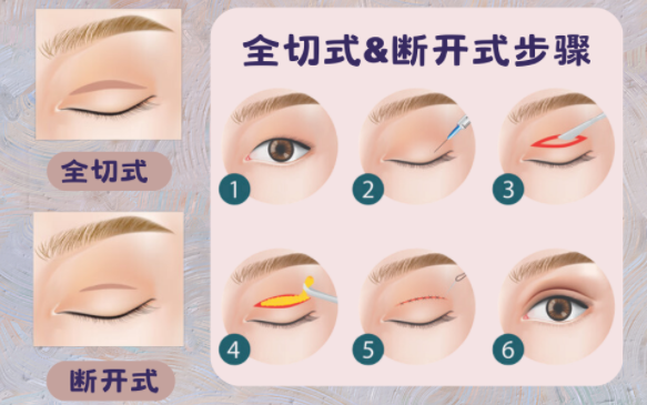 如何修复割双眼皮后出现的凹陷问题 如何修复割双眼皮后出现的凹陷问题