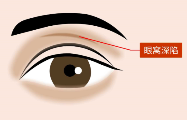 眼窝凹陷填充脂肪：效果能维持多久？