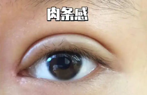 双眼皮肉条明显,该如何处理? 双眼皮肉条明显,该如何处理?