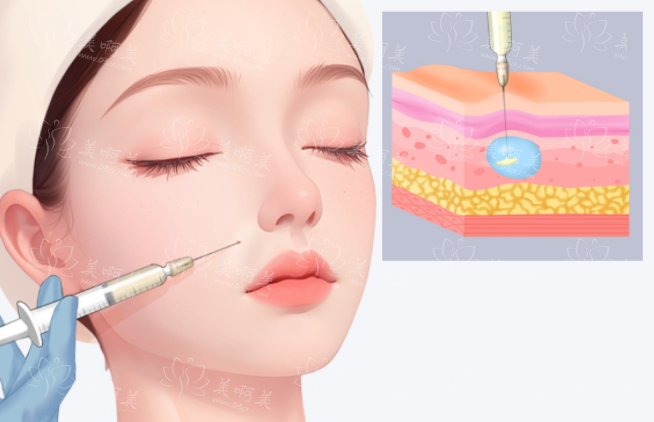 爱贝芙填充法令纹:剂量与注意事项 爱贝芙填充法令纹:剂量与注意事项