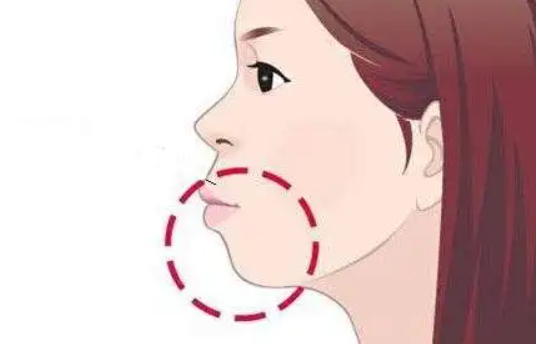 玻尿酸垫下巴：效果与注意事项全解析