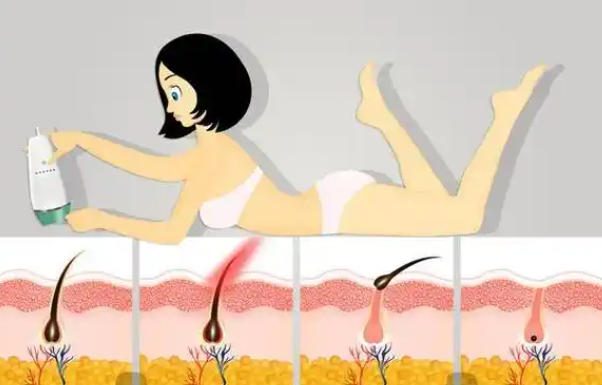 激光脱毛有害吗？可能存在的风险和并发症解析